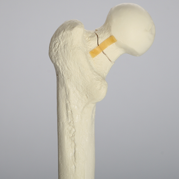Femur with Neck Fracture