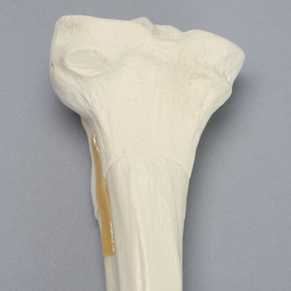Tibia with Oblique Fracture and Hollow Core