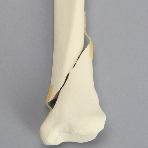 Tibia with Condylar, Oblique, and Spiral Fractures