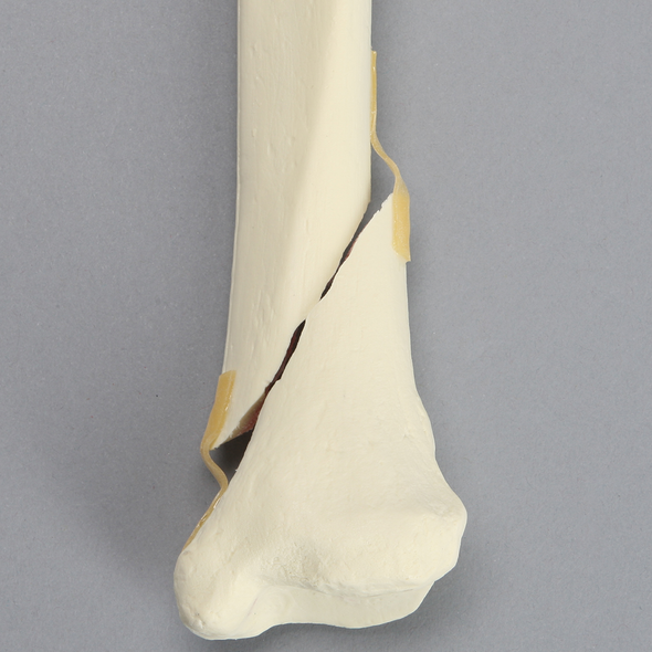 Tibia with Condylar, Oblique, and Spiral Fractures