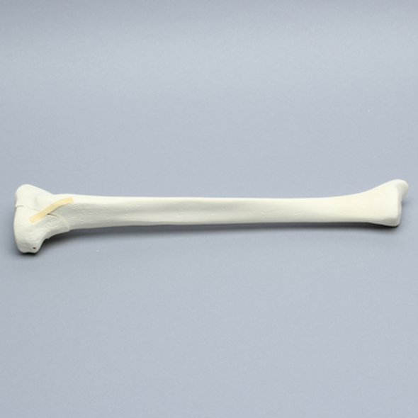 Tibia with Condylar Fracture