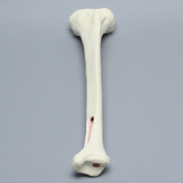 Tibia for IM Nail with Distal Window