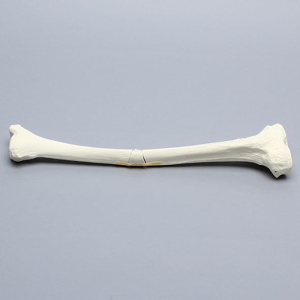 Tibia with Small Butterfly Fracture