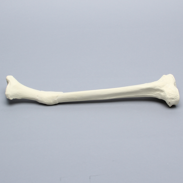 Tibia with Distal Malunion and 25 Degree Varus Defect, Foam Cortical