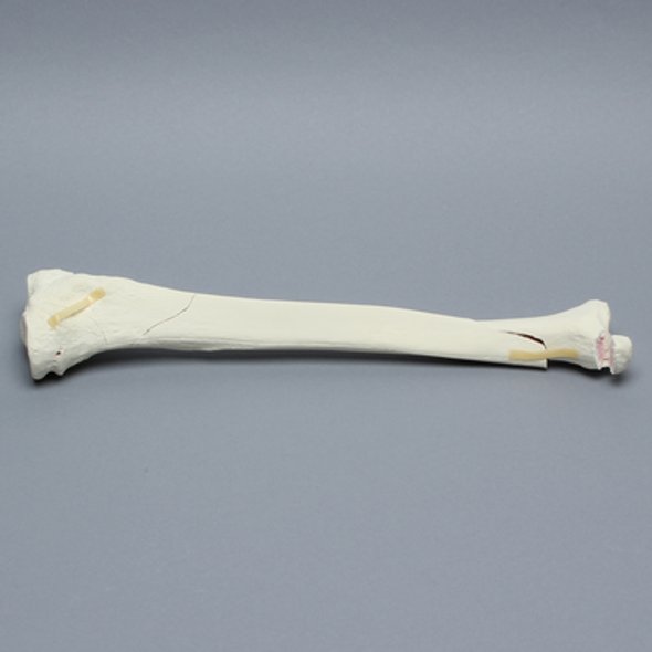 Tibia with Condylar, Malleolar, Oblique, and Spiral Fractures