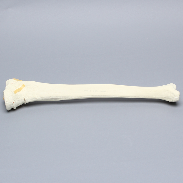 Tibia with "Y" Fracture