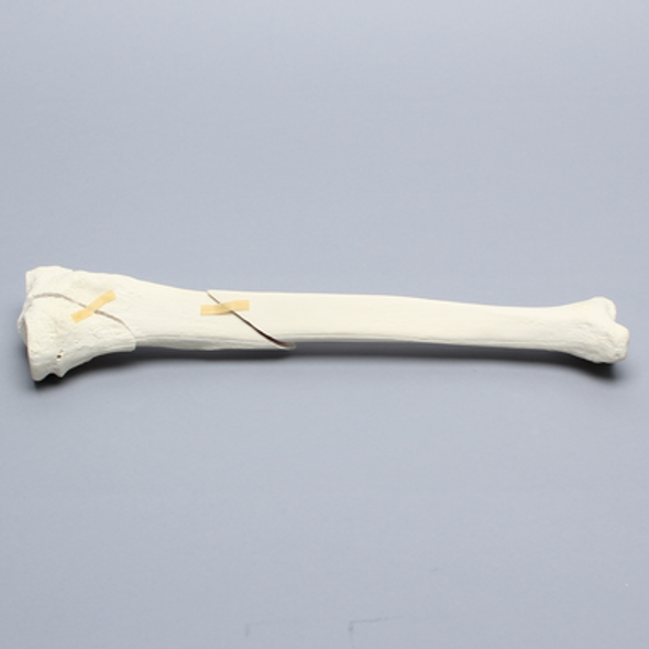 Tibia with Condylar and Oblique Fractures