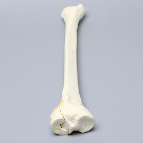 Tibia with Condylar Fracture and Fragment