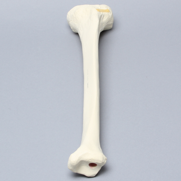 Tibia with Condylar Fracture and Fragment
