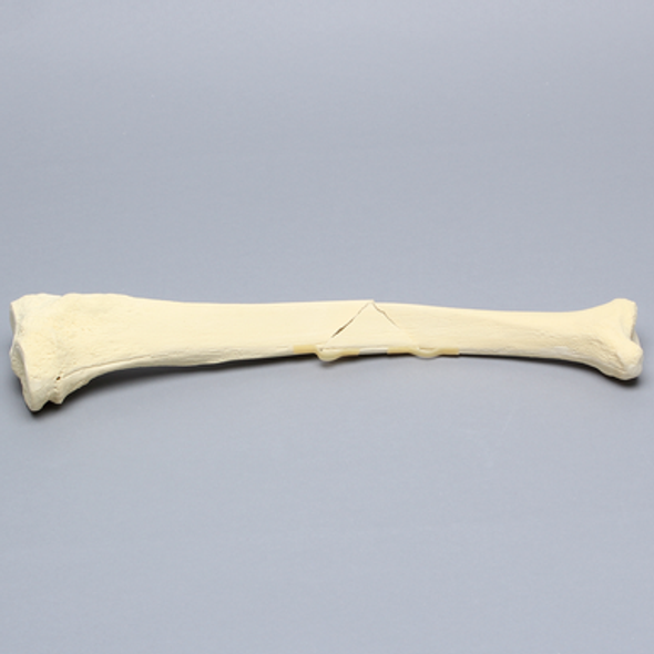 Tibia with Butterfly Fracture