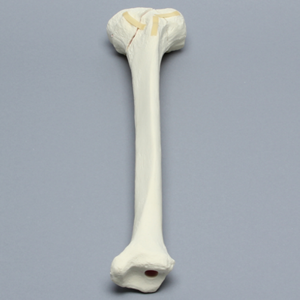 Tibia with Bicondylar and Oblique Fractures