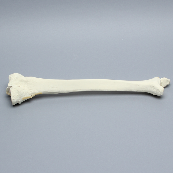 Tibia and Fibula with Bicondylar Fracture