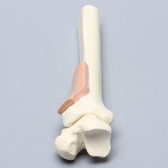 Tibia with Skin Patch and Talus