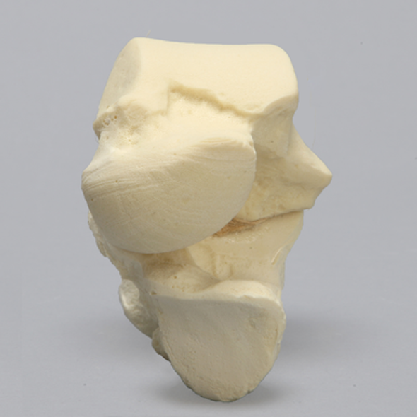 Talus and Calcaneus, Talocalcaneal Joint, Solid Foam