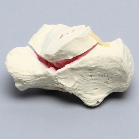 Calcaneus with Four-Part Fracture, Foam Cortical, Left