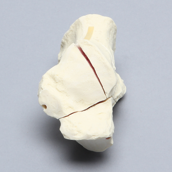 Calcaneus with Four-Part Fracture, Foam Cortical, Left