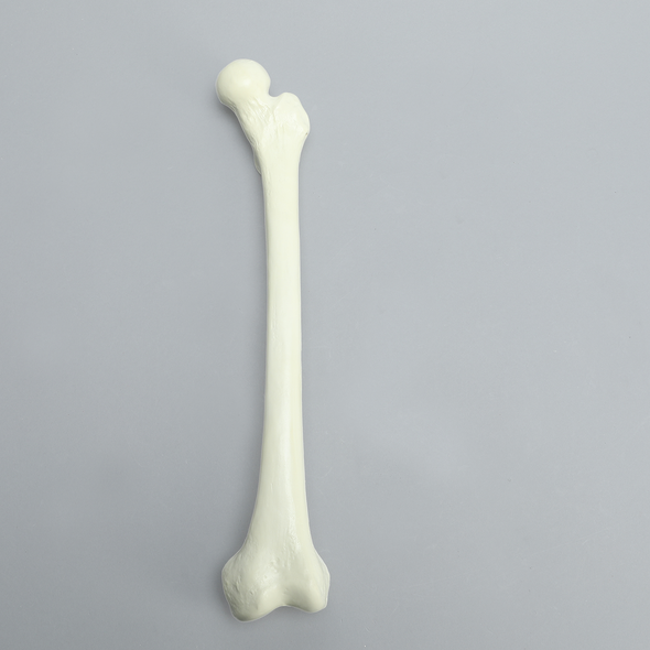 Femur with Neck Deformity, Pediatric