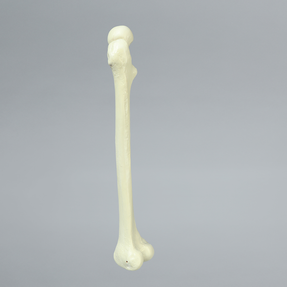 Femur with Neck Deformity, Pediatric