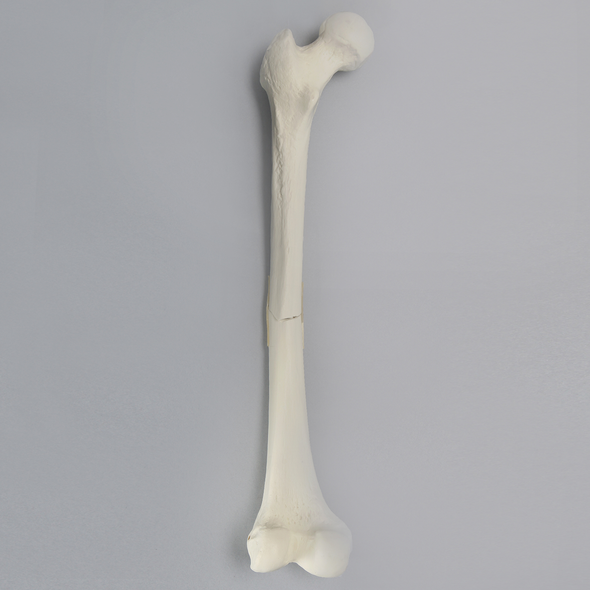 Femur with Light Density Cancellous and Fracture