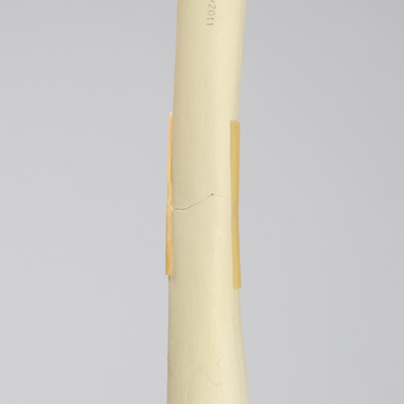 Femur with Transverse Fracture, Foam Cortical, Left, Small