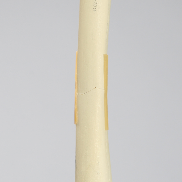 Femur with Transverse Fracture, Foam Cortical, Left, Small