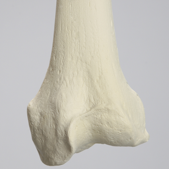 Femur with Arthritis, Foam Cortical, Left, Medium