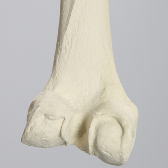 Femur with Arthritis, Foam Cortical, Left, Medium