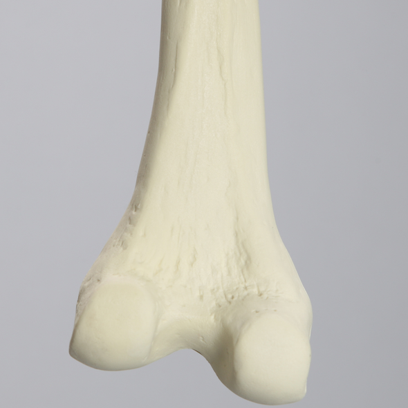Femur, 10 Degree Distal Valgus Deformity, Foam Cortical, Left