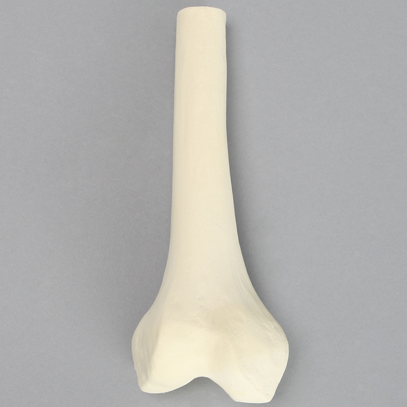 Femur, Distal with 15 mm Canal, Right