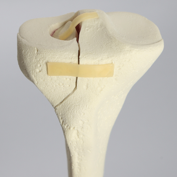 Tibia with Condylar Fracture and Fragment, Right, Medium