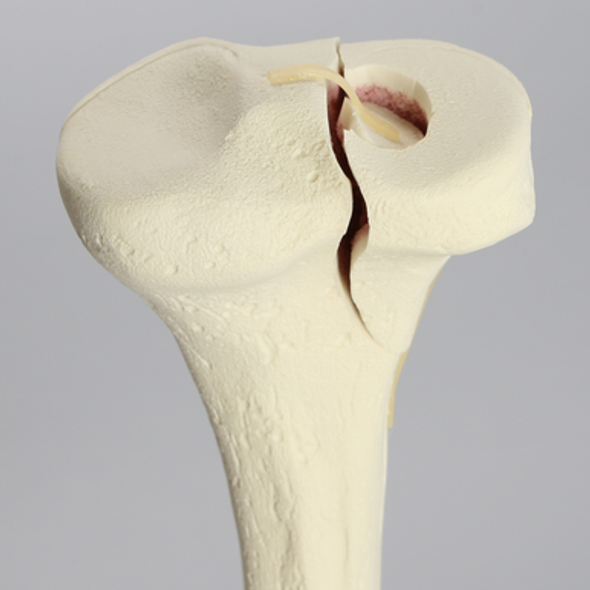 Tibia with Condylar Fracture and Fragment, Right, Medium