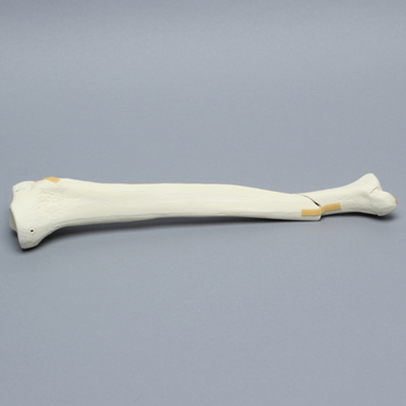 Tibia with Plateau, Spiral, and Malleolar Fractures, Left