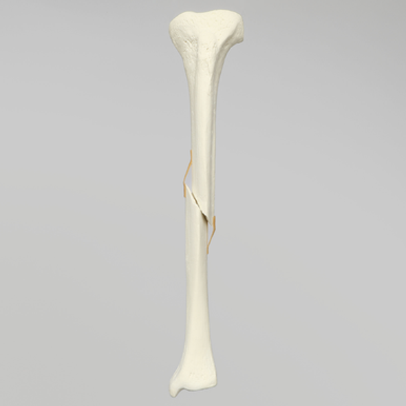 Tibia with Fracture, Foam Cortical, Left, Medium