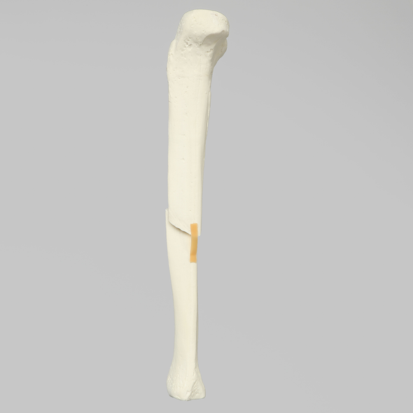 Tibia with Fracture, Foam Cortical, Left, Medium