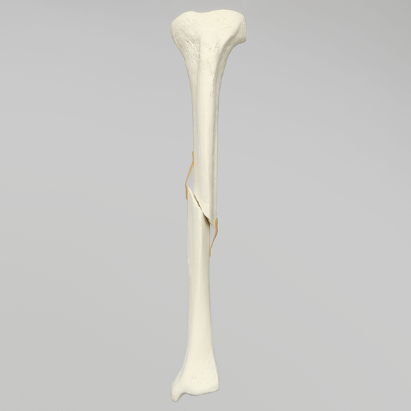 Tibia with Fracture, Foam Cortical, Left, Medium