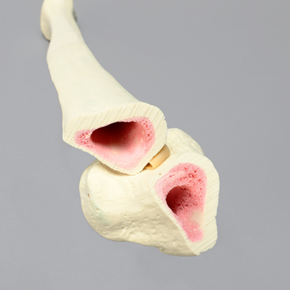 Tibia with 12 mm Canal, Oblique Fracture for IM Nail