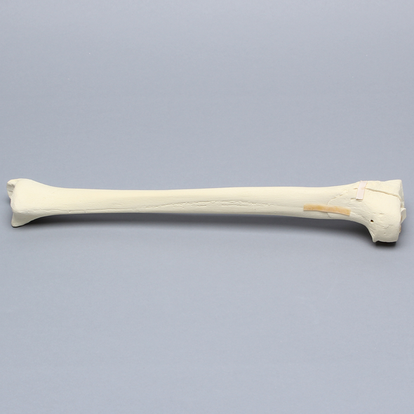 Tibia with Displaced Condylar Fracture and Fragment