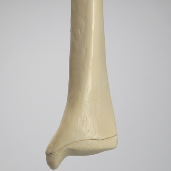 Tibia with Osteoporotic Cortex, Left, Medium