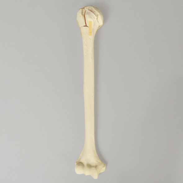 Humerus with Four-Part Bicipital Groove Fracture, Foam Cortical, Right