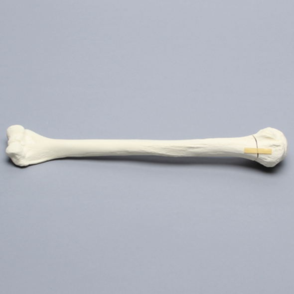 Humerus with Neck Fracture, Foam Cortical