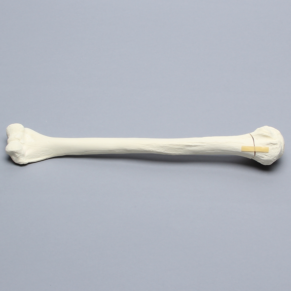 Humerus with Neck Fracture, Foam Cortical