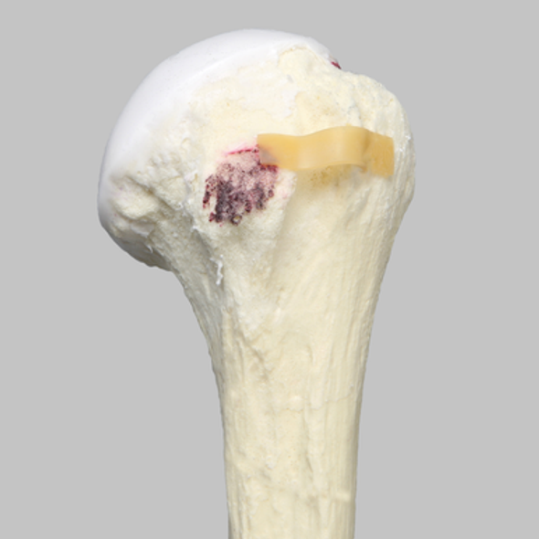 Humerus Replacement with Hill-Sachs Lesion