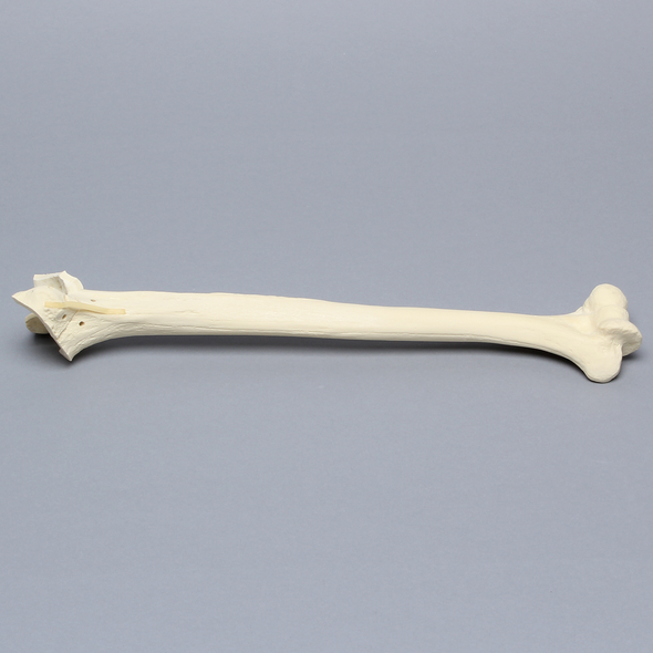 Humerus with Fractures and Suture Holes, Foam Cortical