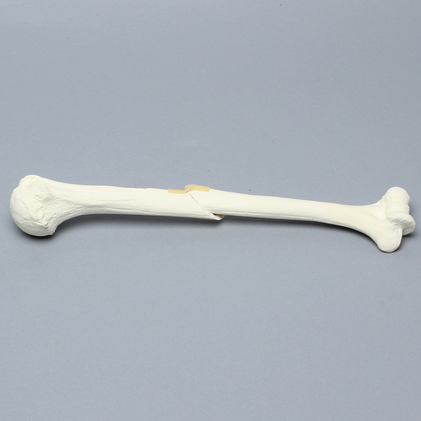Humerus with Oblique Fracture, Foam Cortical
