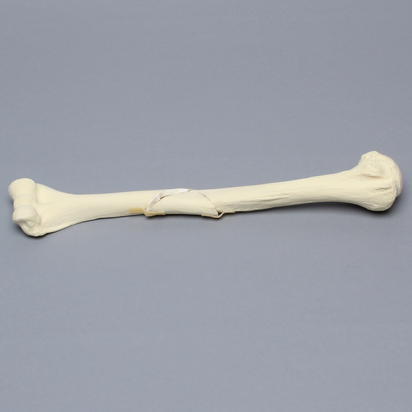 Humerus with Butterfly Fracture, Foam Cortical