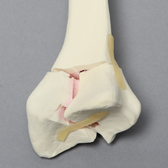 Radius with Three-Part Intra-Articular Fracture, Foam Cortical, Right