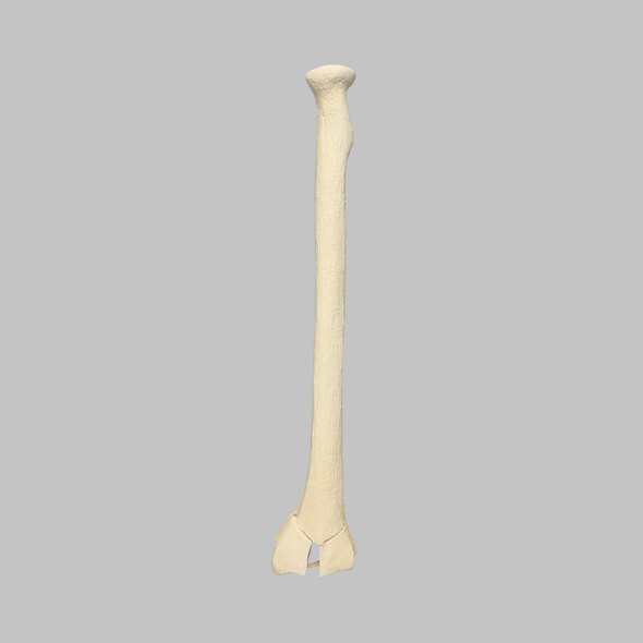 Radius with Three-Part Intra-Articular Fracture and Removed Tubercle, Foam Cortical