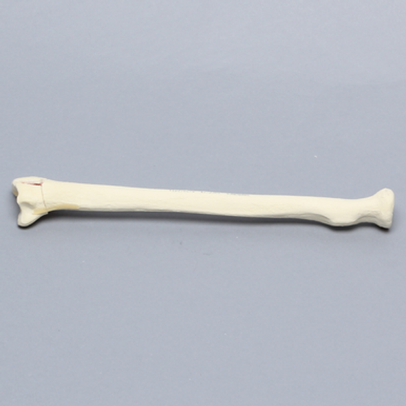 Radius with Three-Part Intra-articular Fracture, Foam Cortical