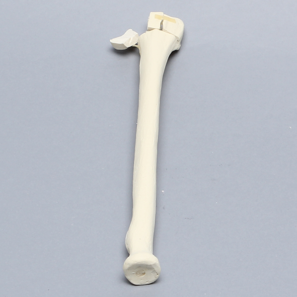 Radius with Distal Five-Part Intra-Articular Fracture, Foam Cortical