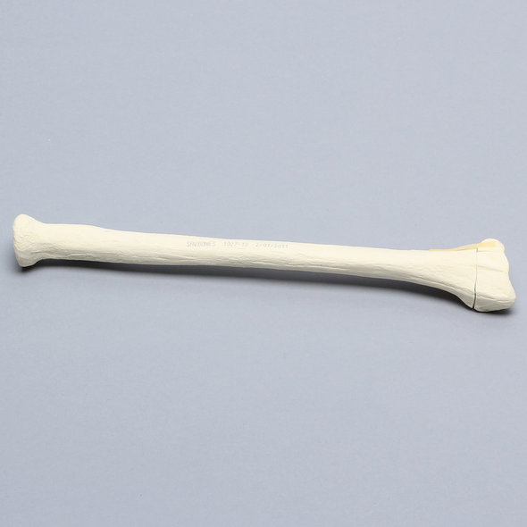 Radius with Transverse Fracture and Fragment, Foam Cortical
